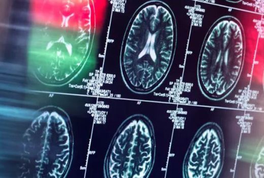 تشخیص اختلال تبدیلی از روی ام‌آرآی