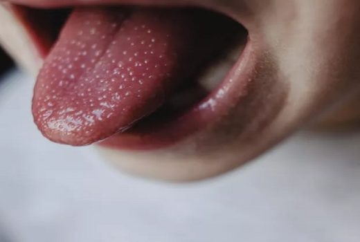 زبان توت فرنگی شکل زمان ابتلا به تب اسکارلت