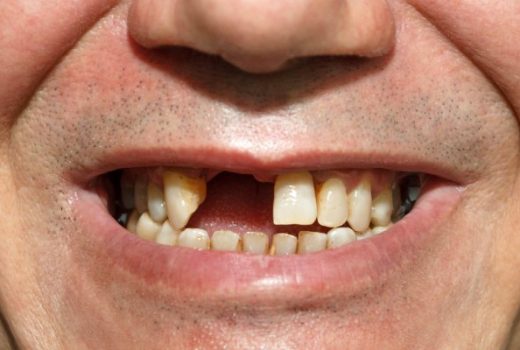 فردی بدون یک دندان جلو - پریودنتیت درمان‌نشده منجر به ازدست‌دادن دندان می‌شود