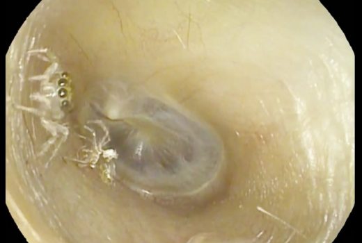 بیرون آوردن عنکبوت از یک گوش زن 64 ساله! + ویدیو