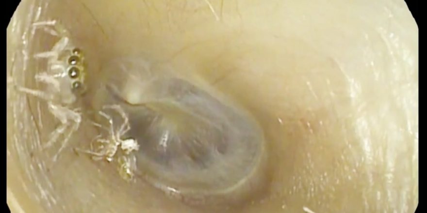 بیرون آوردن عنکبوت از یک گوش زن 64 ساله! + ویدیو