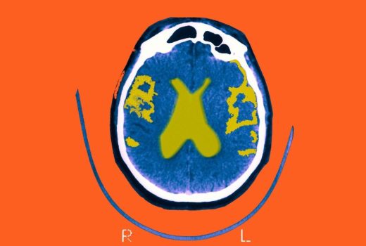 چاقی و تخریب اعصاب مغز