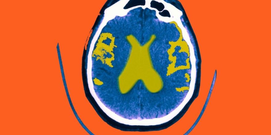 چاقی و تخریب اعصاب مغز