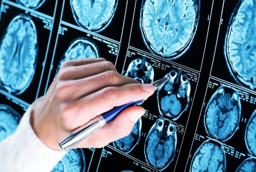 خطر ابتلا به زوال عقل با کمبود ویتامین D و افسردگی افزایش می‌یابد