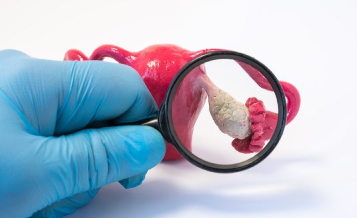 بررسی تخمدان با ذره‌بین