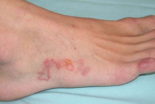 عفونت انگلی - عفونت انگلی - علائم عفونت انگلی