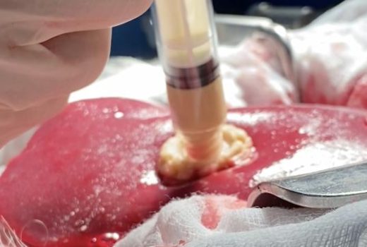 هموستاتیک گیاهی؛ نوآوری جدید برای کنترل سریع خونریزی