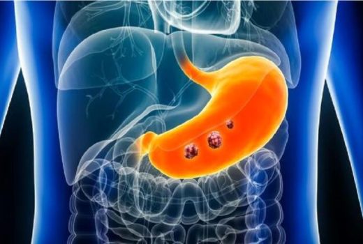 پیشرفت چشمگیر در تشخیص زودهنگام سرطان معده با استفاده از هوش مصنوعی