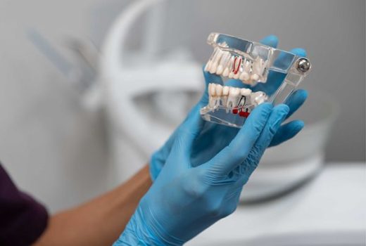 ایمپلنت دیجیتال