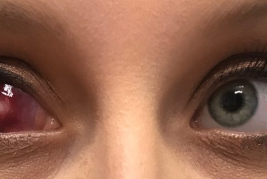 چربی داخل چشم پینگوکولا