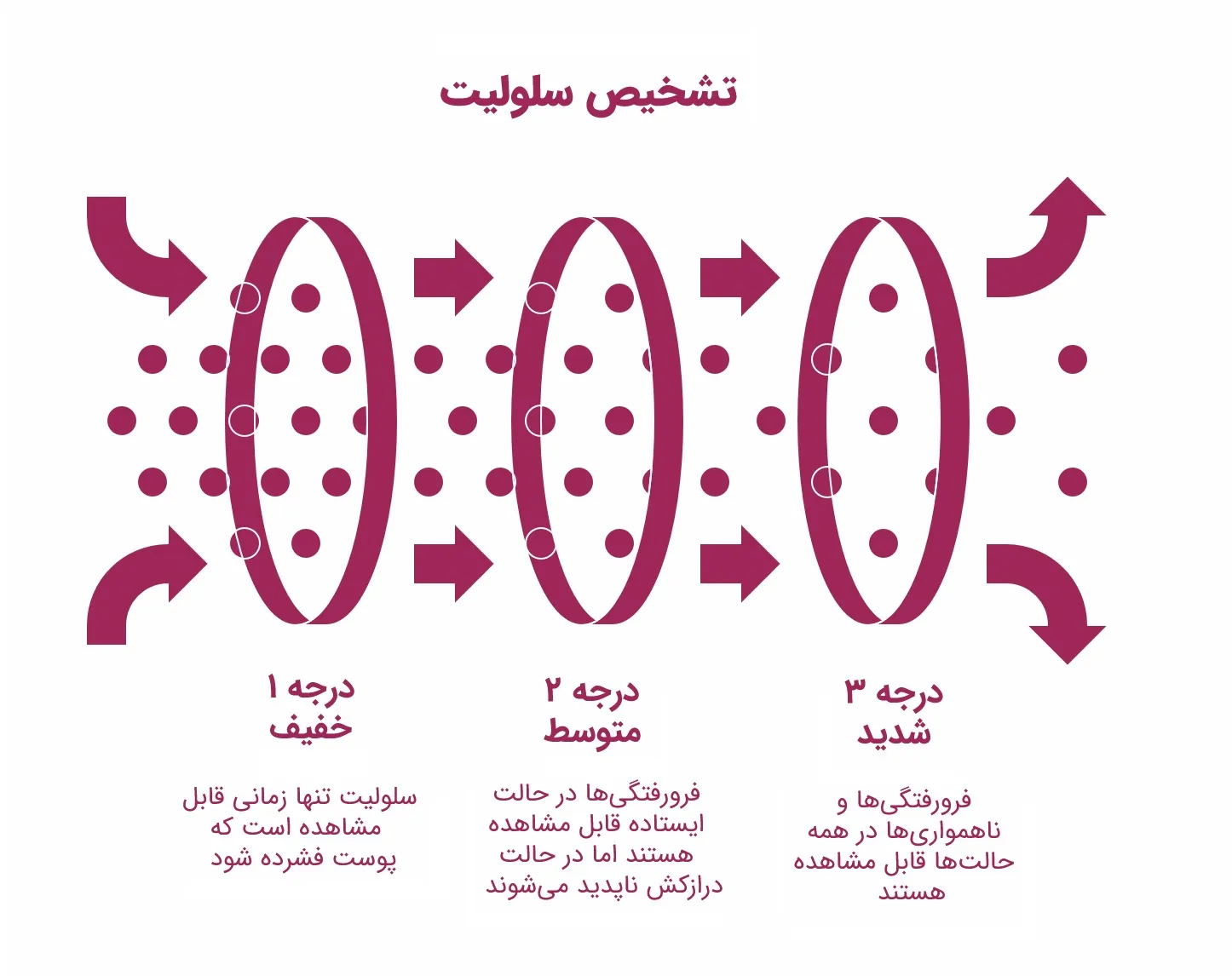 تفاوت لیپیدما و سلولیت: راهنمای تشخیص و درمان_سیاه پوش 36 اینفوگرافیک درجهبندی شدت سلولیت
